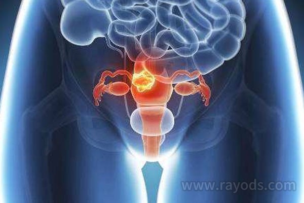 患有子宫内膜异位症不能受孕怎么办？